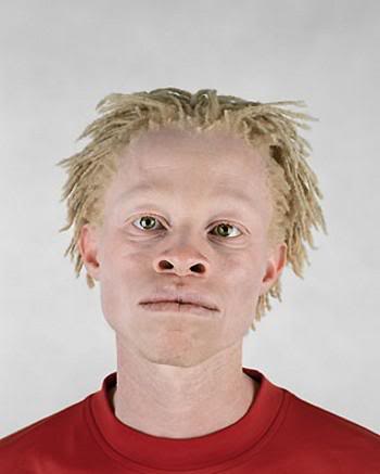 African albinos hunted for their 'magical powers' | Women's Views on News